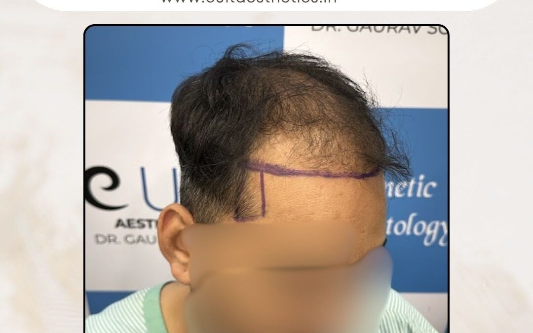 Hair Case 371 Before 2