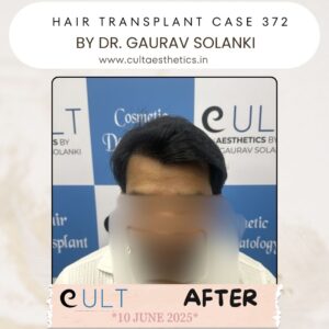 hair case 372 After-1