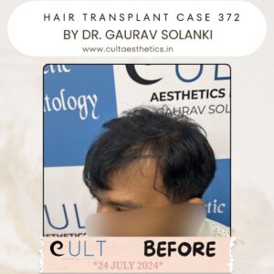 hair case 372 Before-3