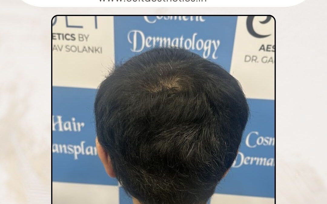 Hair Case 373 After 1