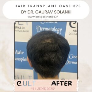 hair case 373 After-1