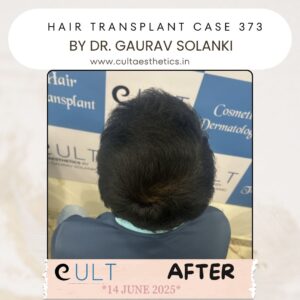 hair case 373 After-3