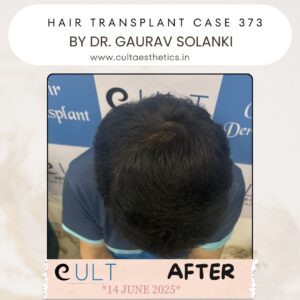 hair case 373 After-4