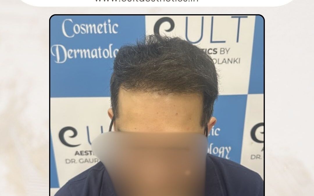 Hair Case 374 After 1