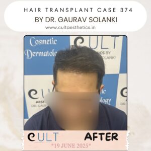 hair case 374 After-1