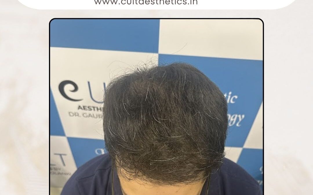 Hair Case 374 After 2