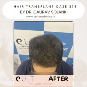 hair case 374 After-2