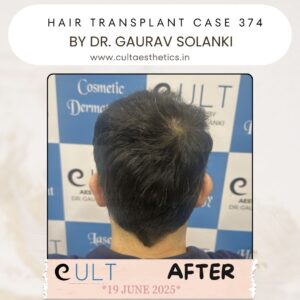hair case 374 After-4