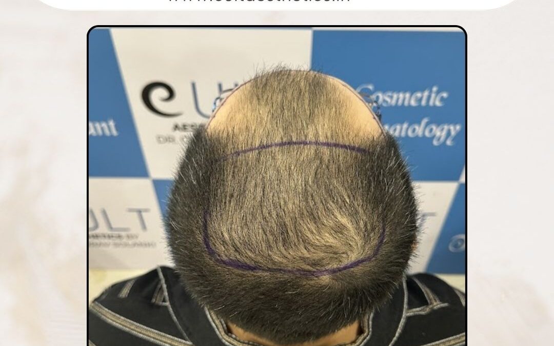 Hair Case 374 Before 3