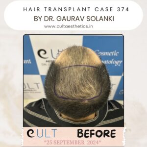 hair case 374 Before-3