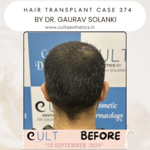 hair case 374 Before-4