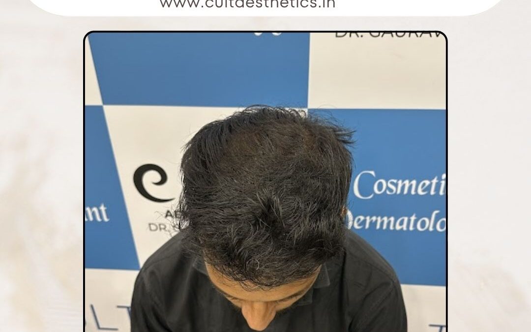 Hair Case 375 After 2