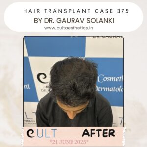 hair case 375 After-2