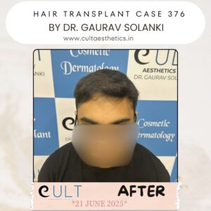 hair case 376 After-1