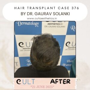 hair case 376 After-3