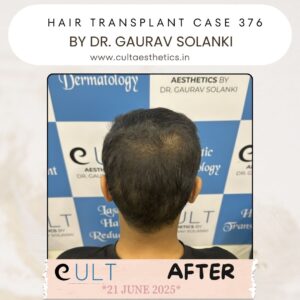 hair case 376 After-4