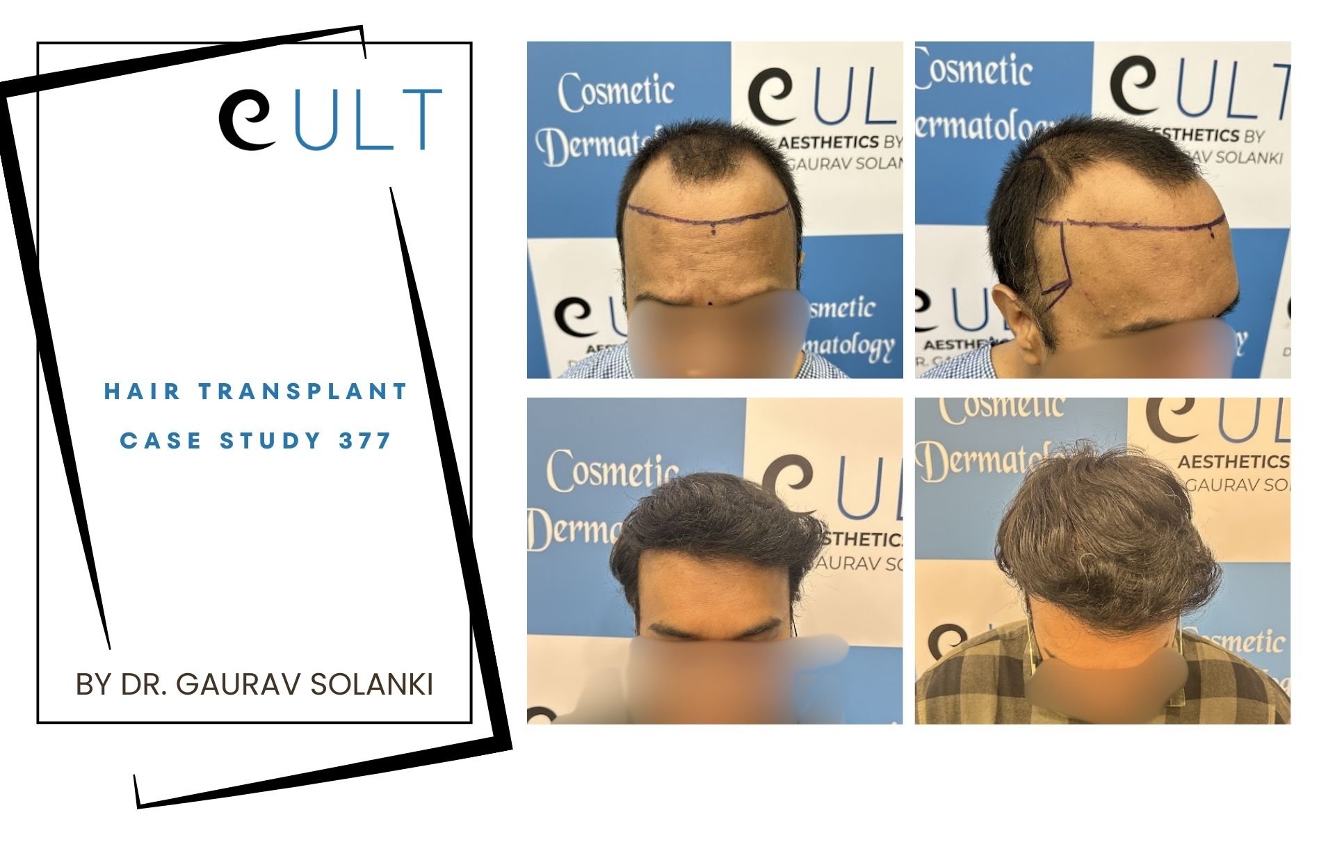 Hair Transplant case 377
