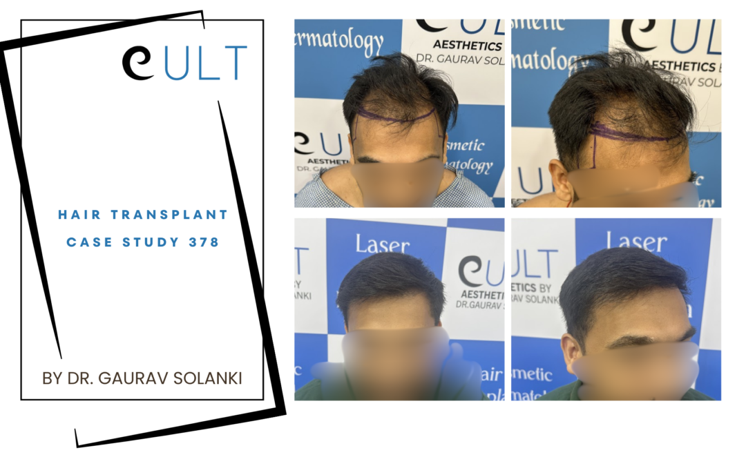 Hair Transplant Case 378