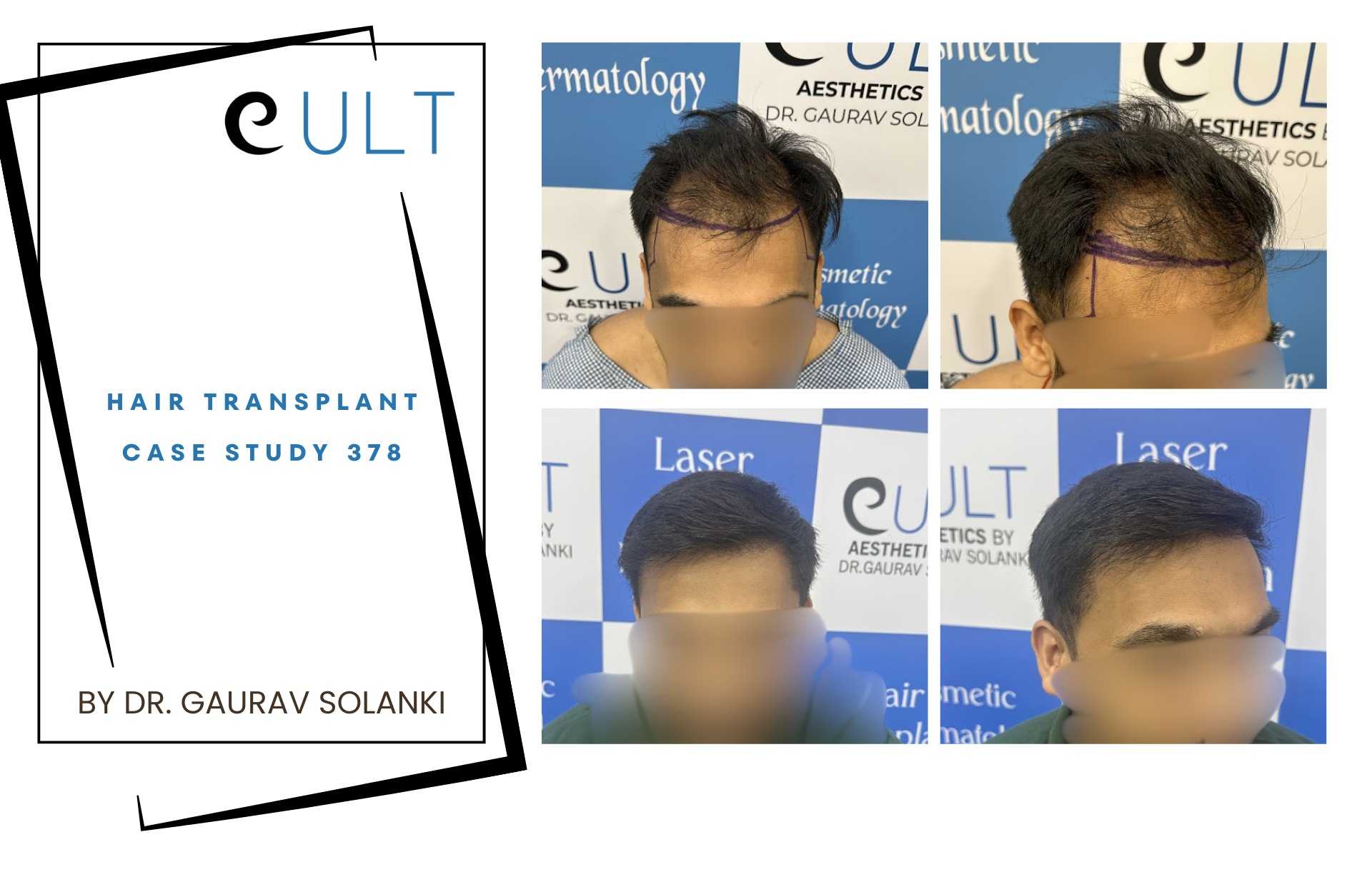 Hair Transplant case 378