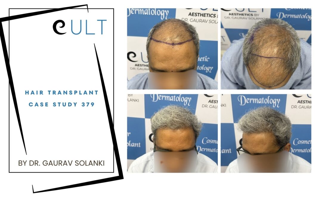 Hair Transplant Case 379