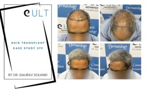 Hair Transplant case 379