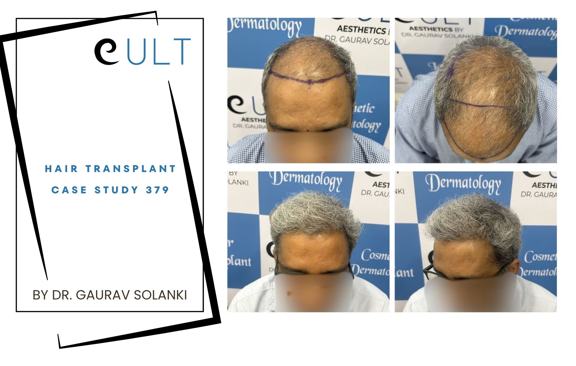 Hair Transplant case 379