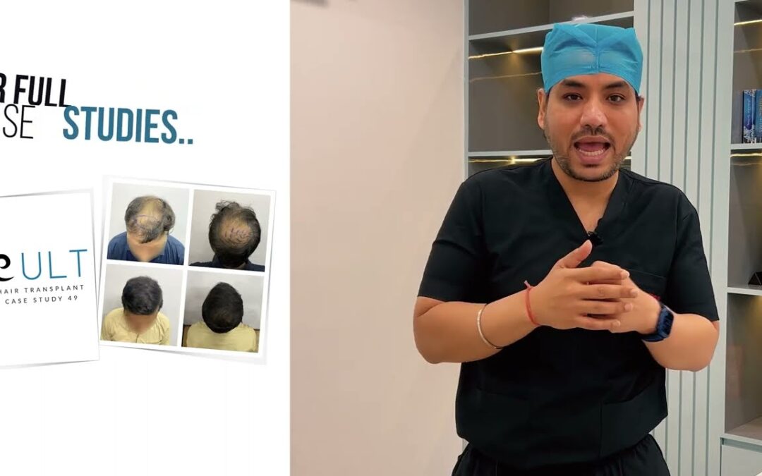 Hair Transplant in Gurgaon: Crown Baldness & Results Explained