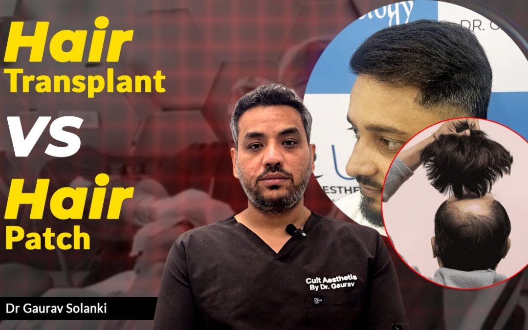 Hair Transplant vs Hair Patch – What’s Better