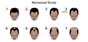 Baldness Grade Chart - Norwood Scale for Hair Loss Classification
