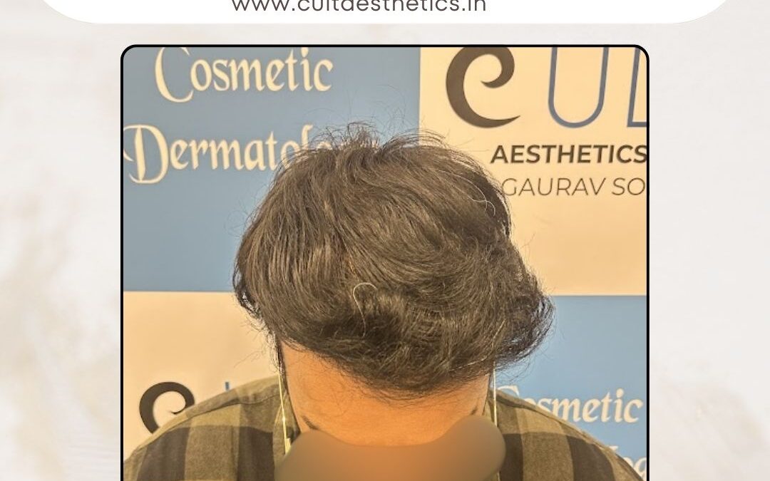 Hair Case 377 After 2