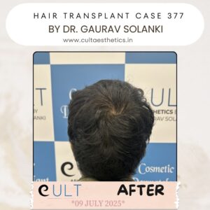 hair case 377 After-4