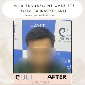 hair case 378 After-1