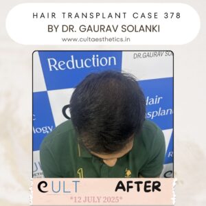 hair case 378 After-4