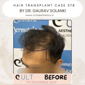 hair case 378 Before-3