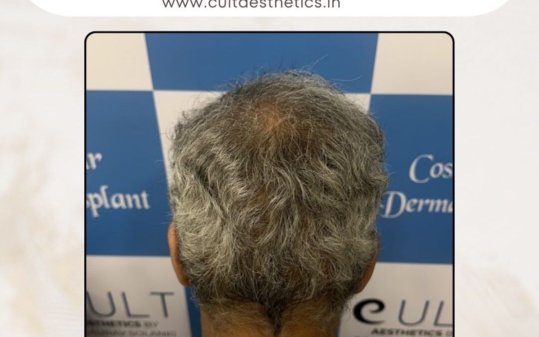 Hair Case 379 After 4