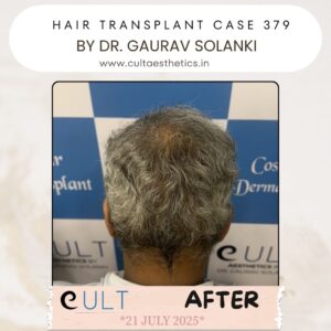 hair case 379 After-4