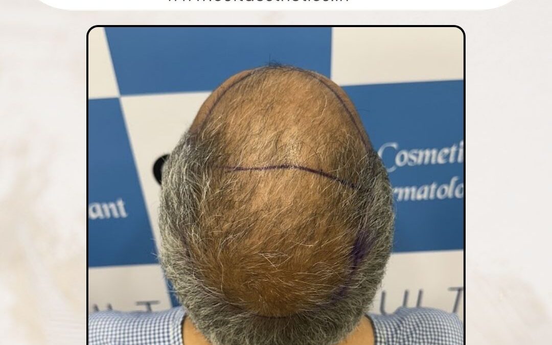 Hair Case 379 Before 3