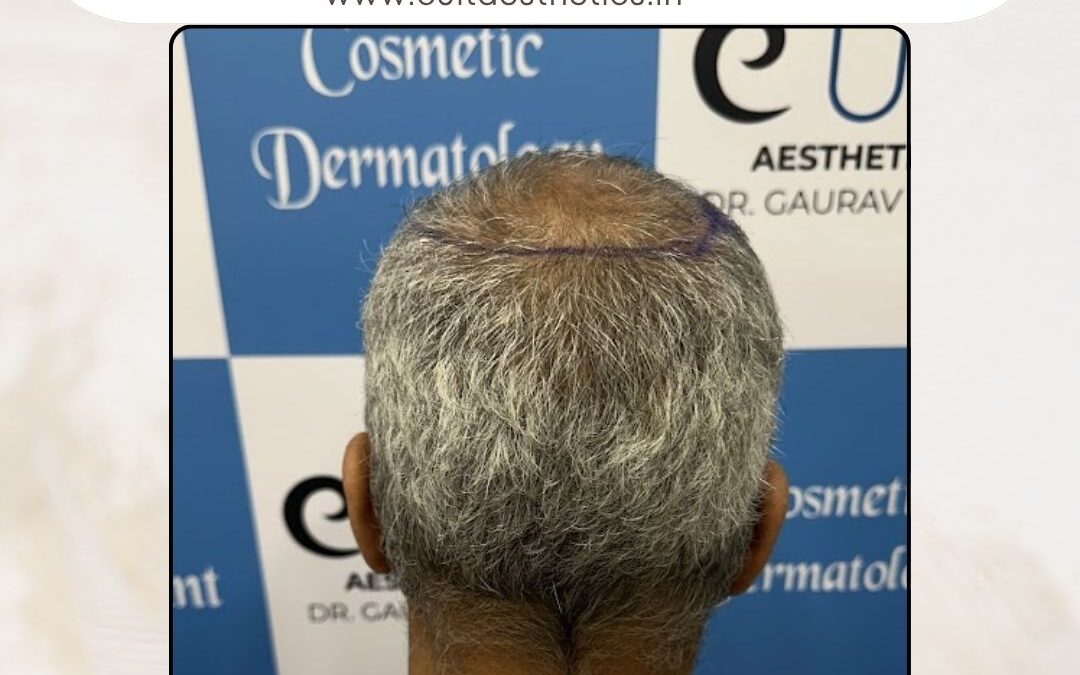 Hair Case 379 Before 4