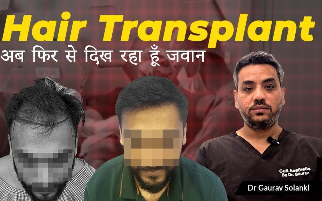 Hair Transplant Case Study: Real Results for Male Pattern Baldness