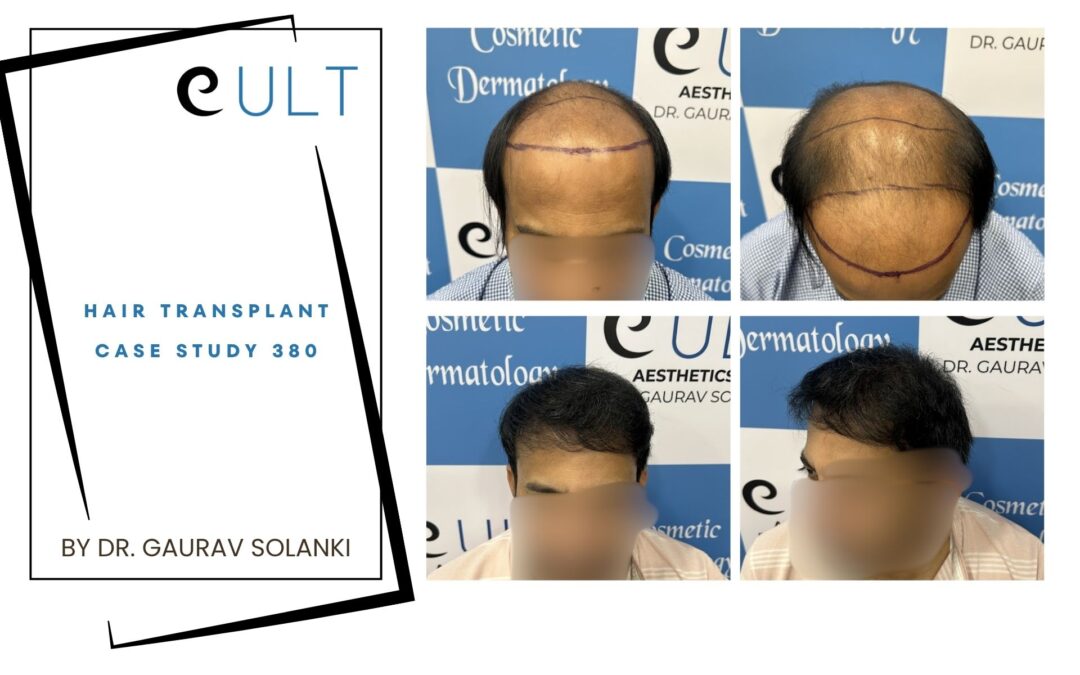 Hair Transplant Case 380