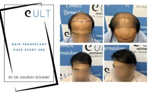 Hair Transplant case 380