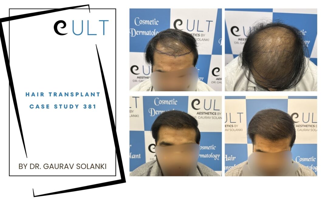 Hair Transplant Case 381
