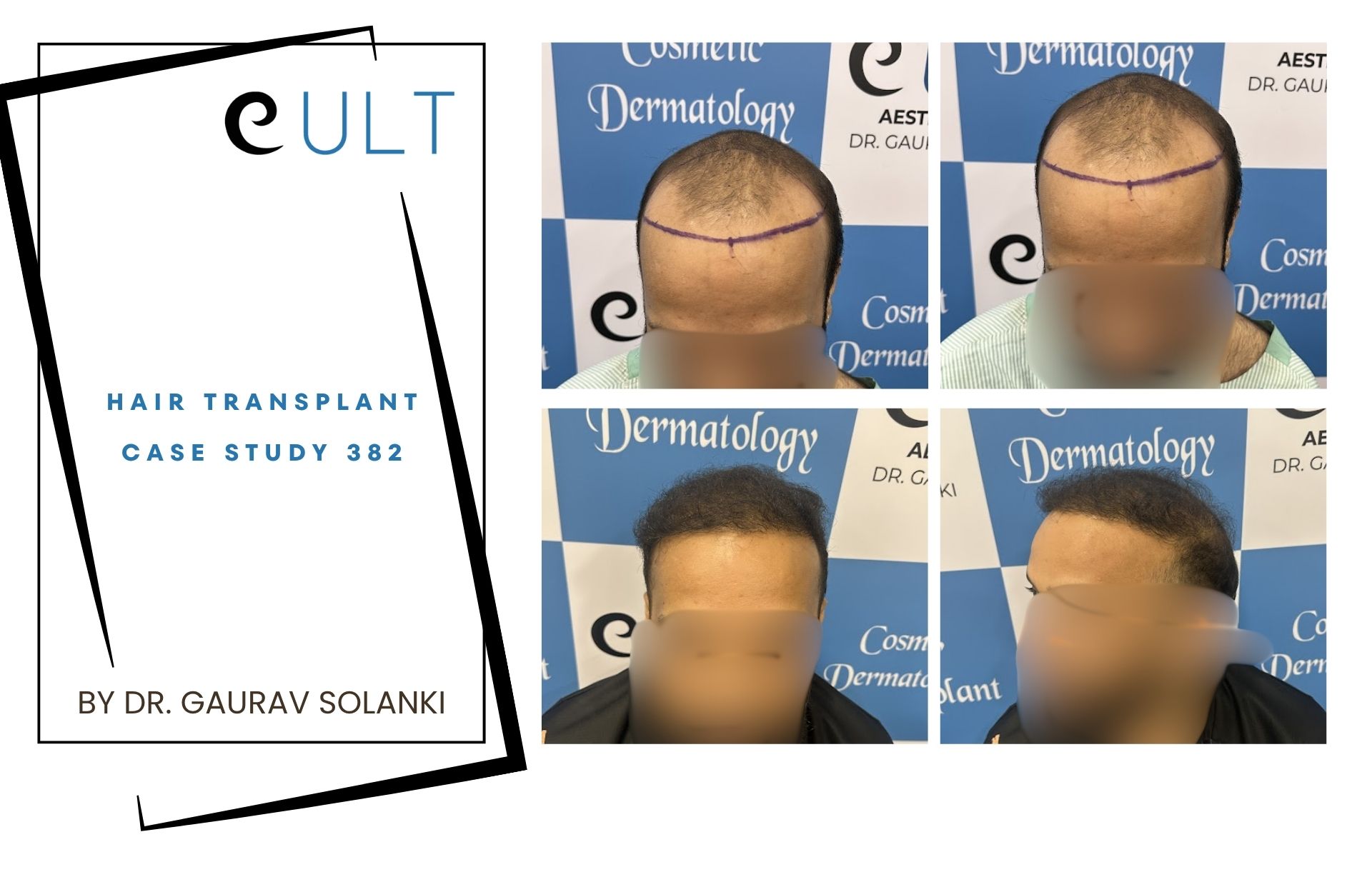 Hair Transplant case 382
