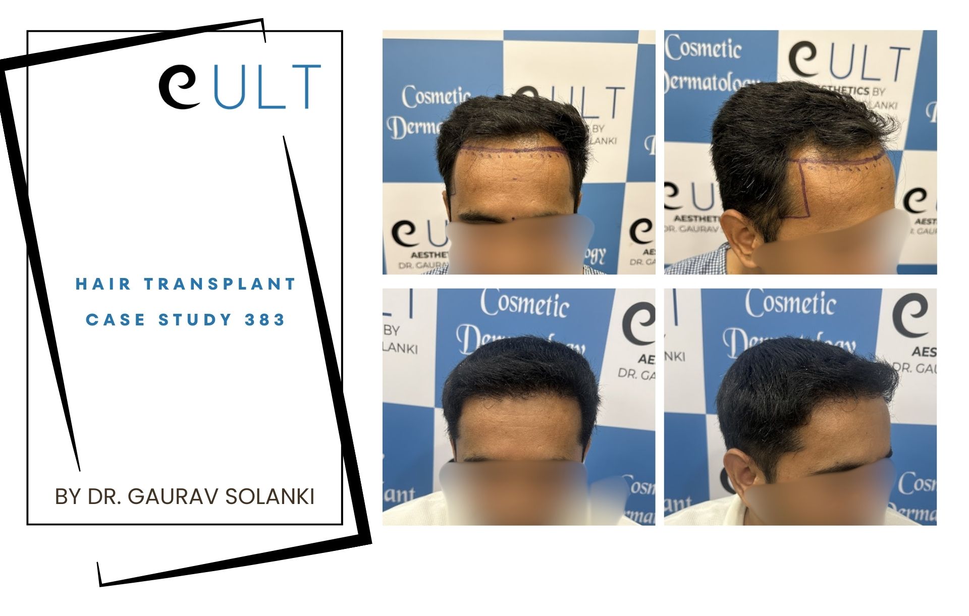 Hair Transplant case 383