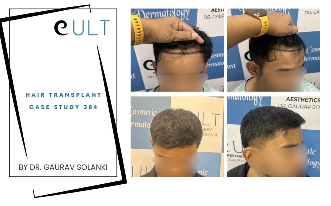 Hair Transplant Case 384