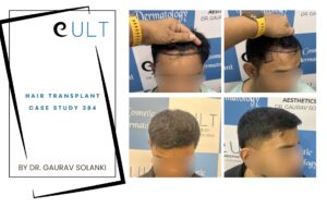 Hair Transplant case 384