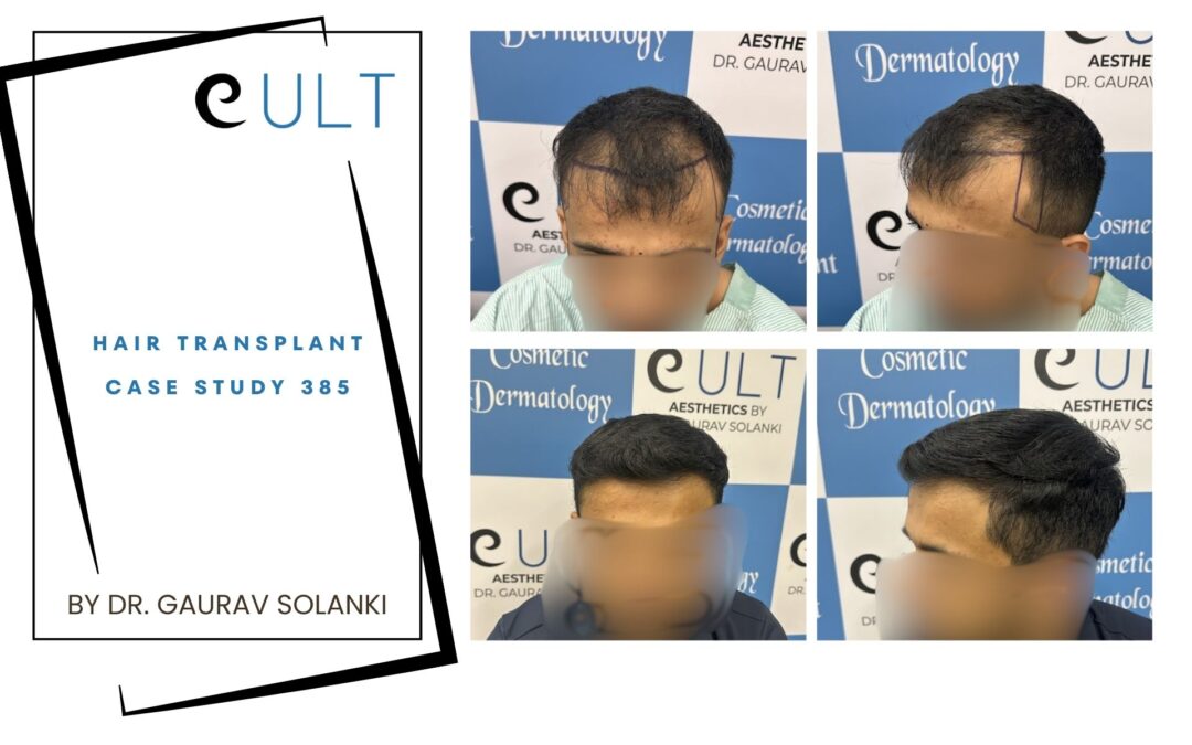 Hair Transplant Case 385