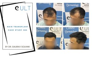Hair Transplant case 385