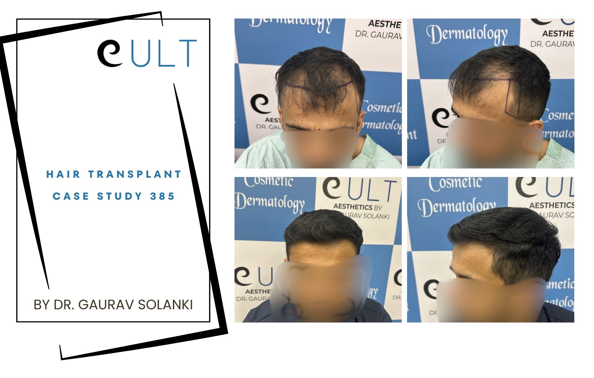 Hair Transplant case 385