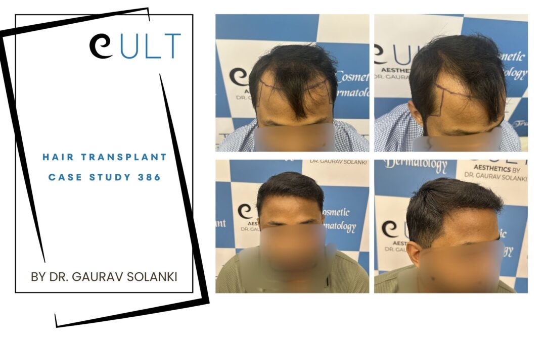 Hair Transplant Case 386